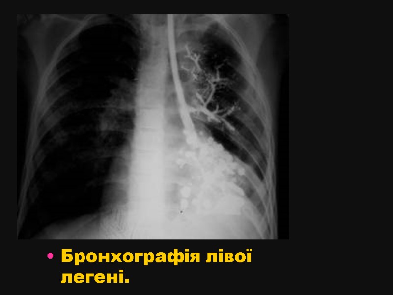 Бронхографія лівої легені.